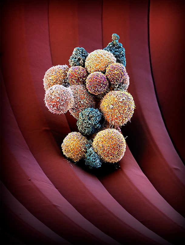 Das Bild stellt einen kolorierten Tumorzellverband dar (CTC-Cluster), der aus dem Blut einer Patientin mit Brustkrebs isoliert wurde und auf einem Mikrochip eingefangen wurde. (Bild: © M. Oeggerli/Micronaut 2018, mit Unterstützung von Pathologie, C-CINA/Biozentrum, I. Krol und N. Aceto, Medizinische Fakultät, Universität Basel und Universitätsspital Basel) Das Bild stellt einen kolorierten Tumorzellverband dar (CTC-Cluster), der aus dem Blut einer Patientin mit Brustkrebs isoliert wurde und auf einem Mikrochip eingefangen wurde. (Bild: © M. Oeggerli/Micronaut 2018, mit Unterstützung von Pathologie, C-CINA/Biozentrum, I. Krol und N. Aceto, Medizinische Fakultät, Universität Basel und Universitätsspital Basel)