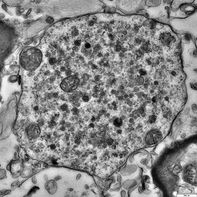 Die elektronenmikroskopische Aufnahme zeigt ein Lewy-Körperchen, ein charakteristisches Merkmal von Parkinson. (Bild: Universität Basel, Biozentrum)