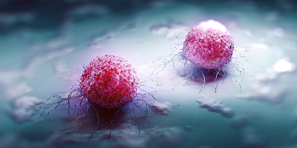 When ovarian cancer alters the abdominal cavity