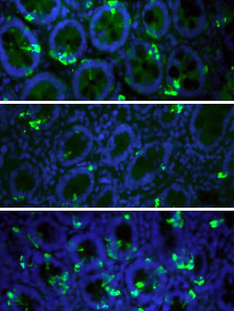 Tissue sections of the duodenum: cells which can release satiety hormones are marked in green. For obese patients (middle), the number of these cells is markedly lower than for lean people (top) and for overweight patients three months after surgery (bottom).
