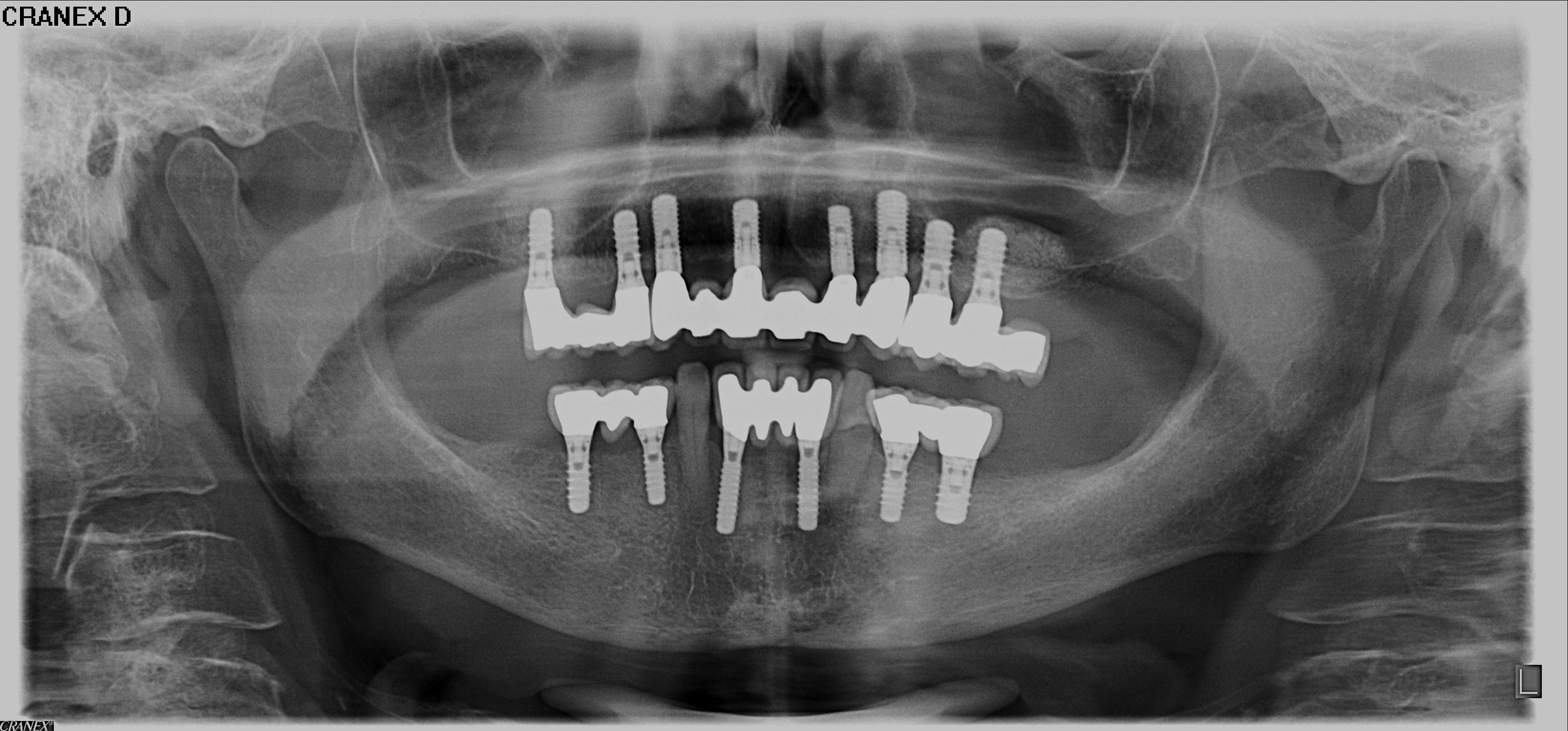 Implantate als Zahnersatz