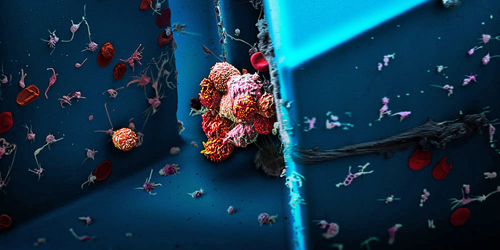Clusters of circulating tumor cells, isolated from the blood of a patient with breast cancer, examined under a scanning electron microscope. (Image: Martin Oeggerli/Micronaut, supported by Nicola Aceto & Ali Fatih Sarioglu)