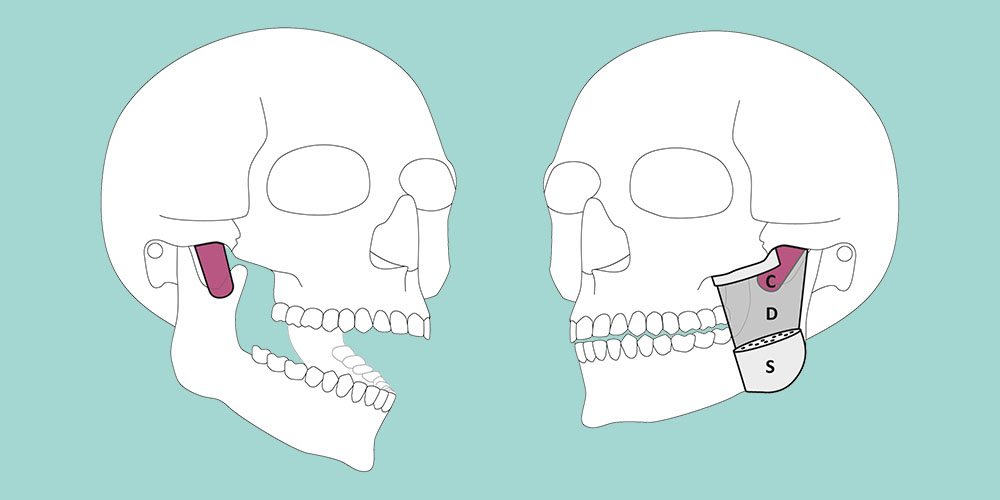 Illustration of the human skull with position and structure of the masseter muscle