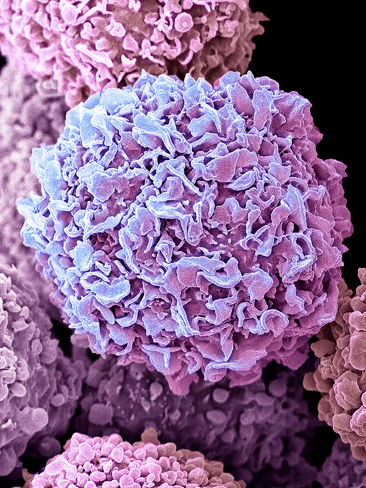 Breast cancer cell with fine surface folds Breast cancer cell with fine surface folds