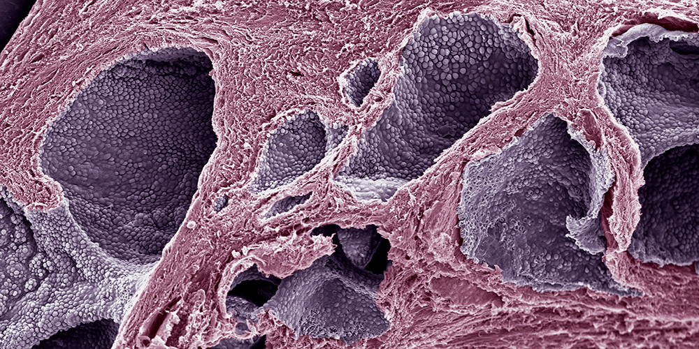Tissue of a prostate carcinoma Tissue of a prostate carcinoma