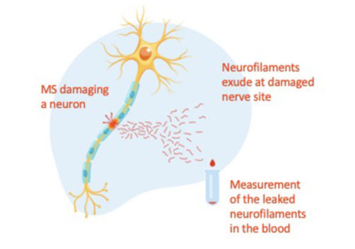 Schematics of a damaged neuron leaking neurofilament