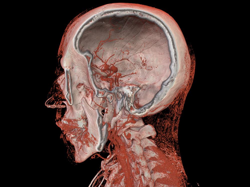 Skull of an aneurysm patient in virtual reality, © University of Basel, CIAN DBE