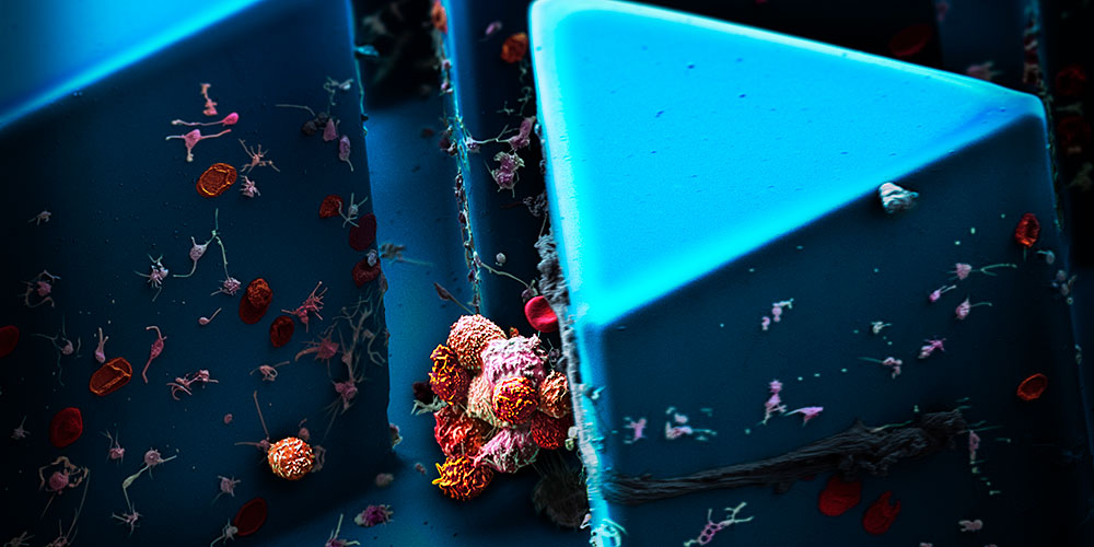 Clusters of circulating tumor cells, isolated from the blood of a patient with breast cancer, examined under a scanning electron microscope. (Image: Martin Oeggerli/Micronaut, supported by Nicola Aceto & Ali Fatih Sarioglu)