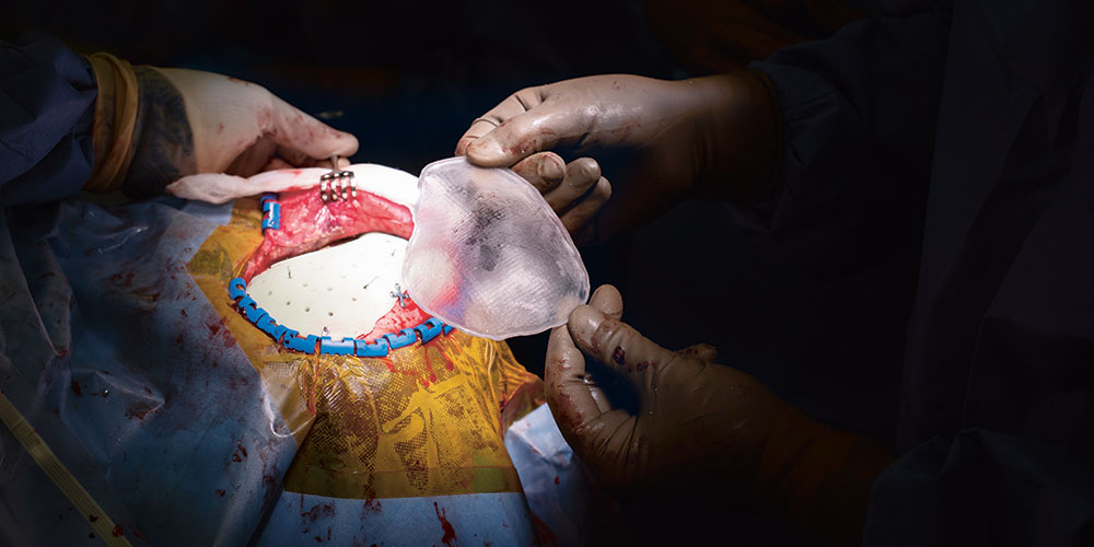 Modell einer künstlichen Schädelplatte: Am Universitätsspital Basel werden 3D-Drucker verwendet, um exakte Implantate herzustellen. (Bild: Universität Basel, Christian Flierl) Modell einer künstlichen Schädelplatte: Am Universitätsspital Basel werden 3D-Drucker verwendet, um exakte Implantate herzustellen. (Bild: Universität Basel, Christian Flierl)