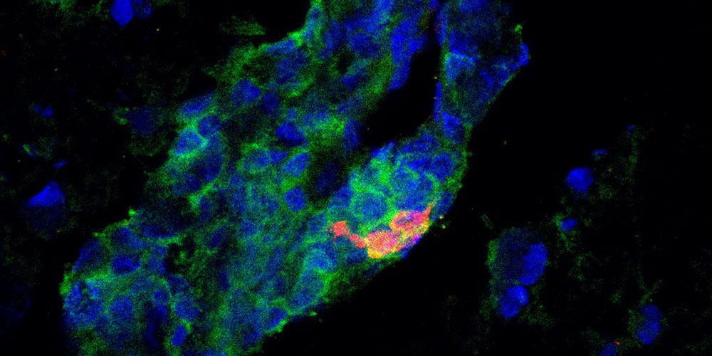 Gut-brain axis influences multiple sclerosis