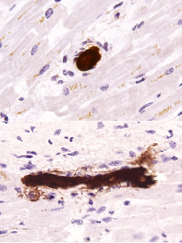 histologische Gewebefärbung einer Mikrothrombose histologische Gewebefärbung einer Mikrothrombose