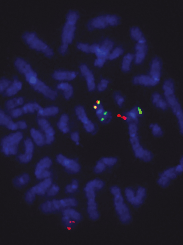 Fusionsgen in Tumorzellen: Rote Signale zeigen den ETO2-Genlokus, grüne den GLIS2-Lokus und die gelben die ETO2-GLIS2-Fusion. © Chrystele Bilhou-Nabera & Nassera Abermil, Hôpital Saint Antoine, Paris. Fusionsgen in Tumorzellen: Rote Signale zeigen den ETO2-Genlokus, grüne den GLIS2-Lokus und die gelben die ETO2-GLIS2-Fusion. © Chrystele Bilhou-Nabera & Nassera Abermil, Hôpital Saint Antoine, Paris.