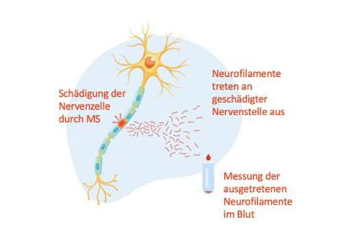 Schema einer geschädigten Nervenzelle bei MS mit austretendem Neurofilament Schema einer geschädigten Nervenzelle bei MS mit austretendem Neurofilament