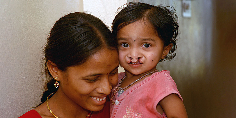 Cleft lip and palate: simpler treatment thanks to artificial intelligence