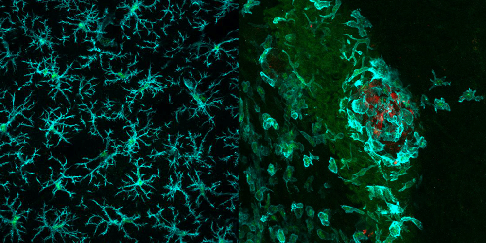 Fluoreszenzmikroskopische Aufnahme von eingefärbten Gewebeschnitten (Maus). Links: Fresszellen (grün) im normalen Gehirn. Rechts: Fresszellen (grün), die einen Tumor (rot) angreifen.