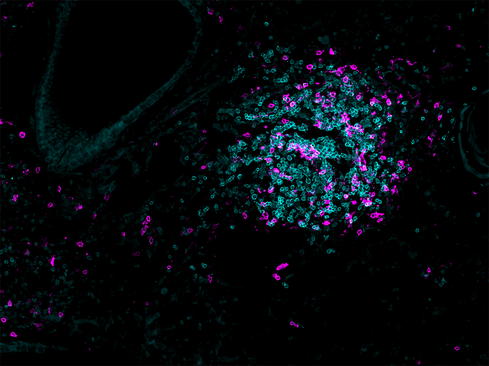 Microscopic image of lung tissue with memory T cells stained in magenta clustering with antibody-producing B cells in cyan. Microscopic image of lung tissue with memory T cells stained in magenta clustering with antibody-producing B cells in cyan.