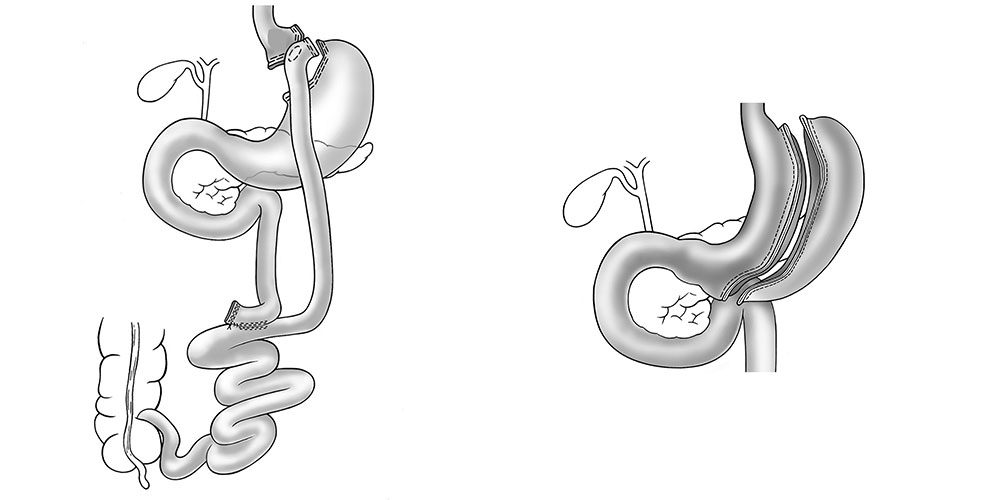 Zwei Operationstypen bei schwerem Übergewicht: Beim Magenbypass wird der Magen durch einen Teil des Dünndarms überbrückt (links), während beim Schlauchmagen das Magenvolumen verkleinert wird (rechts). (Illustrationen: USZ, Viszeralchirurgie)