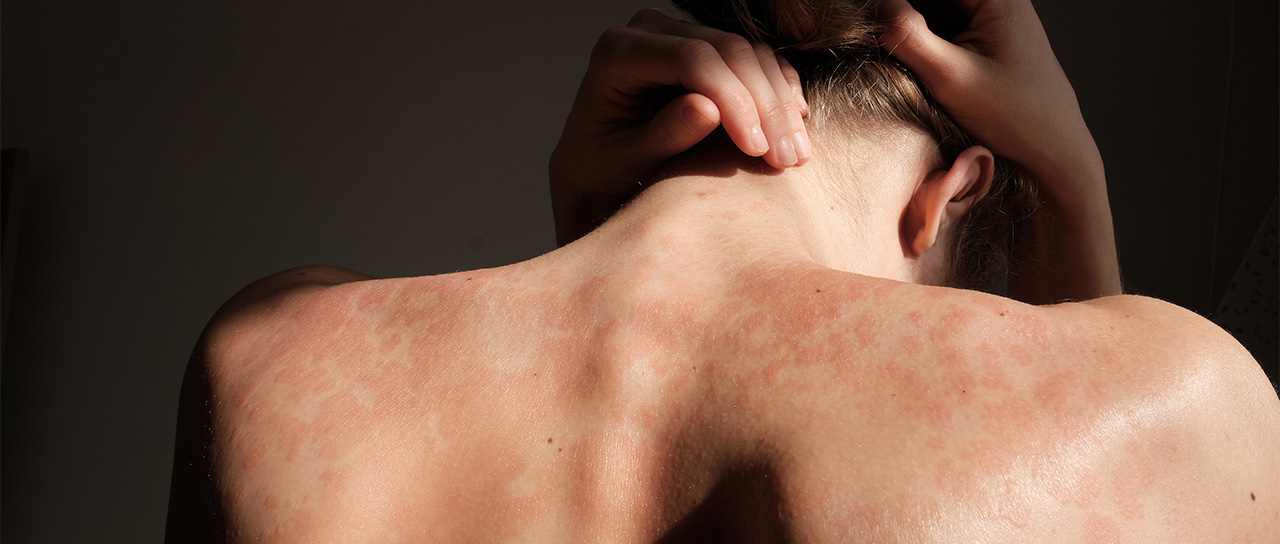 a woman with a rash on her shoulders and her back