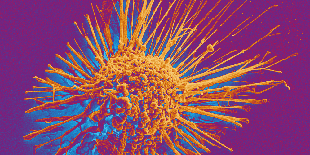 Mit dem Rasterelektronenmikroskop aufgenommene Krebszelle. (Bild: Universität Basel, Swiss Nanoscience Institute/Biozentrum)