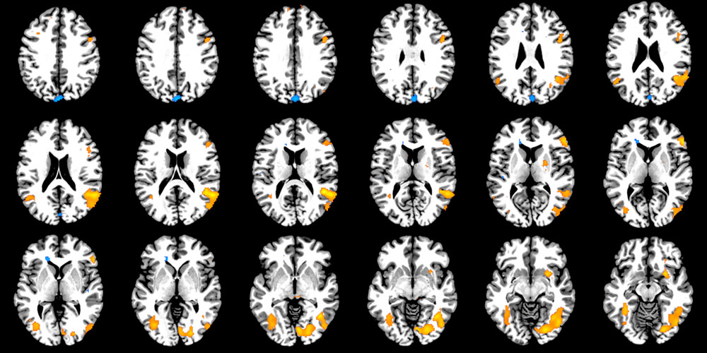 Beispiele von Schnittbildern des Gehirns. In gelber Farbe sind Anstiege, in blauer Farbe Verminderungen der Hirnaktivierung als Reaktion auf eine MRT-Aufgabe abgebildet. (Bild: Nora Raschle )