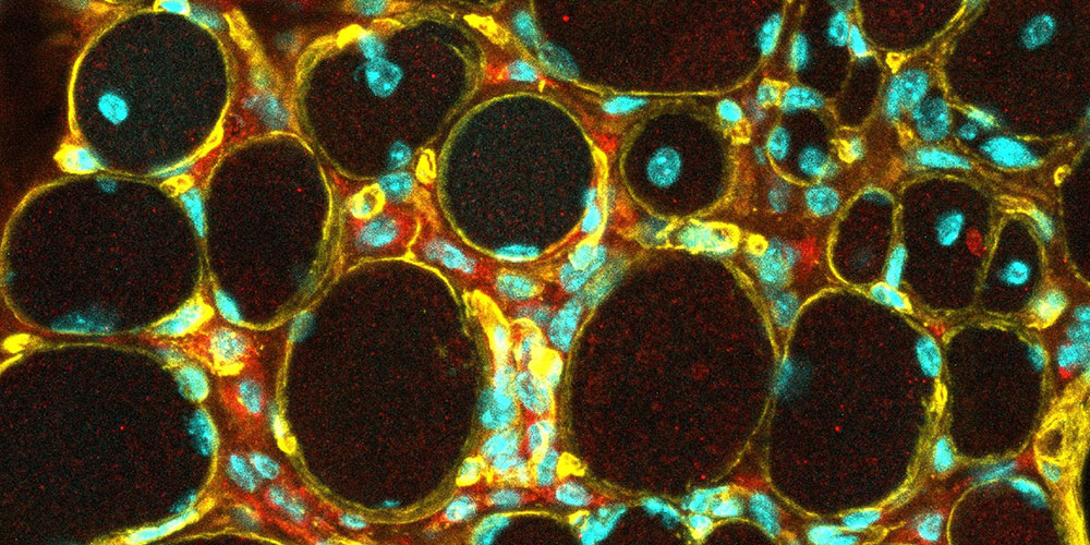 Incurable muscle disease: First successes in the development of a gene therapy