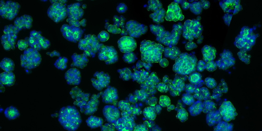 Cancer research: Metabolite drives tumor development