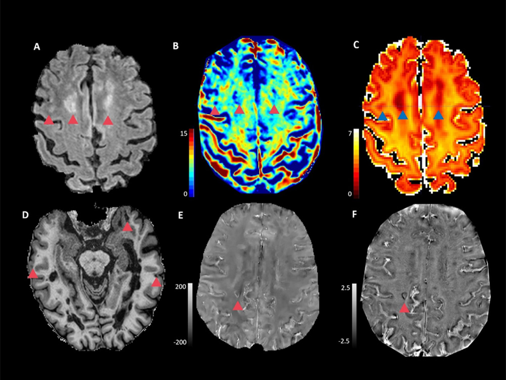 MS patient brain scans MS patient brain scans